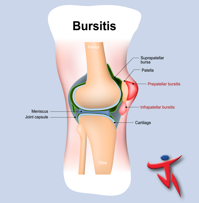 Services-Bursitis Illustration of knee with bursa pockets inflamed to show bursitis.