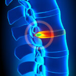 Services-Herniated-disc Illustration of a herniated disc protruding.