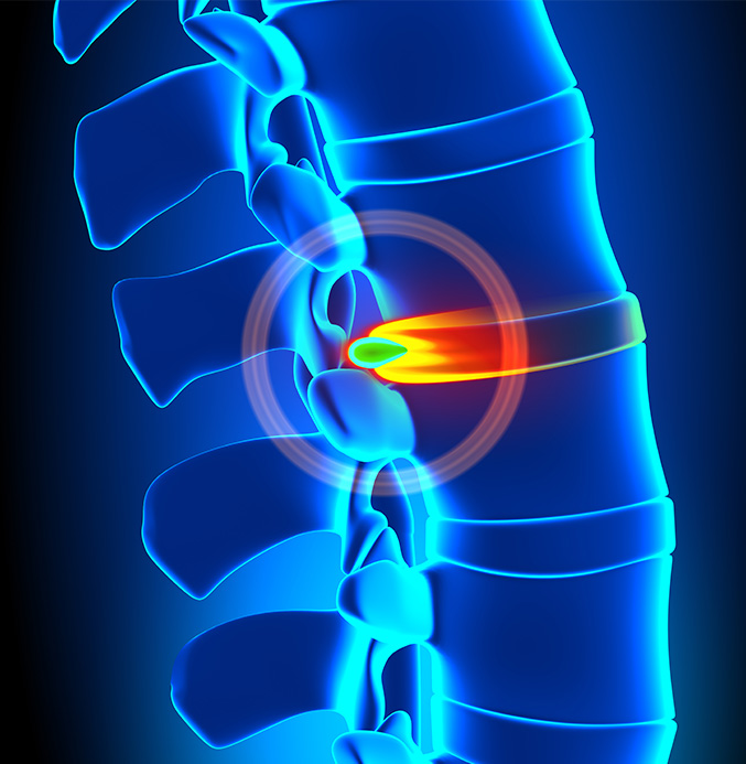 Services-Herniated-disc Illustration of a herniated disc protruding.